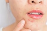 Nếu còn mắc 4 sai lầm này hàng ngày da bạn sẽ càng nổi nhiều mụn