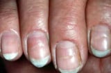 5 dấu hiệu bất thường trên móng tay cảnh báo ung thư: Đừng chủ quan kẻo phát hiện quá muộn