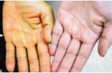 5 dấu hiệu cảnh báo bệnh gan của bạn đã đi vào giai đoạn nặng: Có 1 cũng nên đi khám sớm