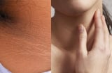 Nhìn thấy dấu hiệu này trên da, cẩn thận Tiểu Đường tới gần
