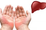 6 dấu hiệu bất thường ở bàn tay, cảnh báo bệnh bạn đang mắc phải