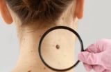 3 dấu hiệu “đen” trên cơ thể cảnh báo ung thư cận kề: Tuyệt đối đừng chủ quan kẻo quá muộn!