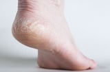 Mẹo giai quyết tình trạng da gót chân khô, nứt nẻ