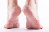 Nứt nẻ gót chân không phải lúc nào cũng do khô, hãy lưu ý những tình trạng này