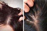 4 cách trị gàu tự nhiên giúp 'đánh bay' nỗi lo về mái tóc nhiều gàu