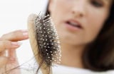 Những thói quen mùa lạnh khiến tình trạng rụng tóc trầm trọng hơn
