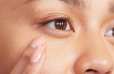 Ghim ngay 5 cách phục tình trạng bọng mắt