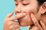 Vì sao chăm sóc da kỹ vẫn bị mụn?
