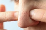 3 mẹo đơn giản giải quyết nỗi lo mụn đầu đen cho nàng