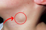 3 dấu hiệu bất thường ở vùng cổ cảnh báo K: Nhiều người chủ quan đã quá muộn