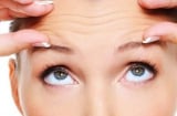 Nếp nhăn vùng trán: Dấu hiệu lão hóa sớm và cách khắc phục