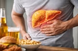 5 Dấu hiệu gan nhiễm mỡ nhưng nhiều người hay bỏ qua