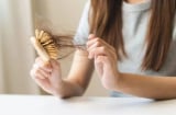 4 vấn đề da đầu âm thầm khiến tóc rụng nhiều hơn và cách xử lý đúng cách