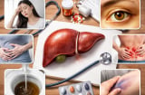 6 dấu hiệu cảnh báo gan suy yếu nhiều người thường bỏ qua, phát hiện sớm để tránh hậu quả nặng