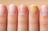 Những thay đổi bất thường ở móng tay có thể là dấu hiệu cảnh báo sức khỏe