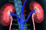 5 dấu hiệu khi ngủ cảnh báo chức năng thận suy yếu: Cẩn thận kẻo chạy thận suốt đời