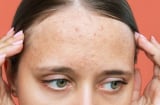Nhận diện sẹo rỗ và 5 phương pháp cải thiện giúp làn da dần mịn màng hơn