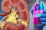 5 giai đoạn hình thành sỏi thận, chỉ vì thói quen uống nhiều nước ngọt