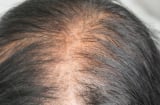 Loại lá chống rụng tóc, kích thích mọc tóc con hiệu quả nhưng đang bị bỏ ph