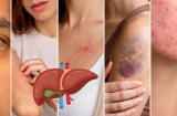Da xuất hiện 5 dấu hiệu này, đừng chủ quan: Gan có thể đang “kêu cứu”