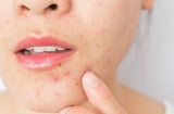 6 sai lầm khiến mụn kéo dài dai dẳng và cách xử lý đúng để da phục hồi hiệu quả