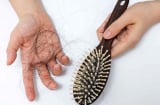 Rụng tóc nhiều: dấu hiệu bình thường hay cảnh báo bất ổn? Cách cải thiện an toàn tại nhà