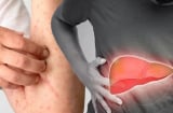 5 biểu hiện sớm của bệnh gan có 1 dấu hiệu cũng nên đi khám sớm