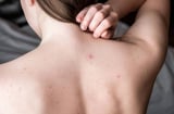 Cải thiện mụn lưng và da sần sùi tại nhà: Routine đơn giản giúp da body mịn màng rõ rệt