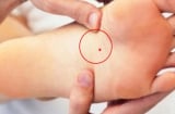 4 nốt ruồi vùng kín mang lại may mắn: Đừng dại xóa đi