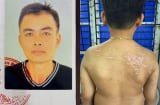 Khởi tố người cha bạo hành con ruột gây thương tích 36% gây phẫn nộ