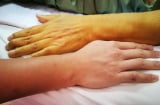 5 dấu hiệu cảnh báo gan thận đang 'kêu cứu', số 1 bệnh đã chuyển nặng