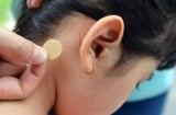 Bé gái 7 tuổi bị rối loạn hành vi, nói nhảm suốt đêm vì tác dụng phụ của miếng dán chống say tàu xe