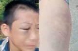 Bé trai nghi bị mẹ kế bạo hành nhiều lần: Người bố lên tiếng xin lỗi gia đình vợ cũ