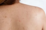Mụn lưng bùng phát vào mùa hè: Những cách chăm sóc giúp da cơ thể thông thoáng hơn