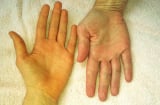 6 dấu hiệu trên cơ thể cảnh báo gan của bạn đang kêu cứu: Nên đi khám gấp