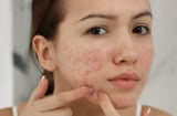 Cách làm mờ thâm mụn bằng kem đánh răng tại nhà