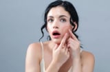 Chăm sóc da đúng cách sau nặn mụn giúp giảm nguy cơ thâm sẹo và phục hồi da nhanh hơn