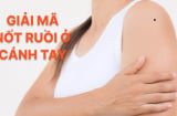 4 nốt ruồi trên cánh tay mang tới may mắn cho bạn: Đừng dại xóa đi