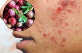 3 đối tượng không được ăn mận: Dễ nổi mụn, nóng trong
