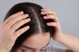 Nguyên nhân gội đầu xong vẫn nhiều gàu và ngứa