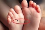 4 nốt ruồi trên chân mang tới may mắn cho bạn: Ai có thật đáng chúc mừng