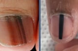 Cảnh báo từ Bác sĩ Da liễu Trung ương: 5 dấu hiệu trên móng tay có thể là 'án tử' ung thư ác tính