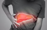 5 dấu hiệu cảnh báo bệnh gan của bạn đã đi vào giai đoạn nặng