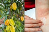  Mách mẹo làm giảm rôm sảy, mẩn ngứa bằng lá khế: Dân gian dùng nhiều nhưng cần biết đúng cách