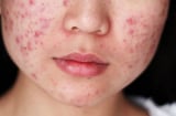 Căng thẳng kéo dài có thể khiến mụn trứng cá dai dẳng và khó kiểm soát