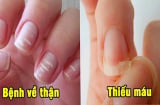Bắt bệnh qua móng tay: Có 1 dấu hiệu cũng nên đi khám sớm
