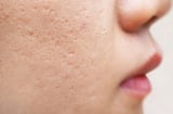 3 lầm tưởng phổ biến về điều trị sẹo mụn khiến nhiều người tốn thời gian mà hiệu quả không như mong đợi