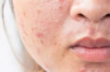 Muốn ngăn mụn tái phát? Đừng bỏ qua 6 bước chăm sóc da giúp duy trì làn da khỏe mạnh