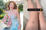 Thúy Ngân đăng tải bức ảnh cận cảnh đôi chân với nhiều vết thương