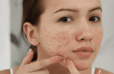 Muốn giảm mụn và hạn chế tái phát, đừng bỏ qua 3 hoạt chất quan trọng trong chu trình chăm sóc da